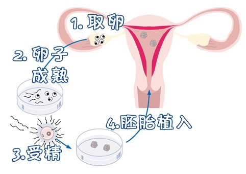 女同伴侣借卵代怀